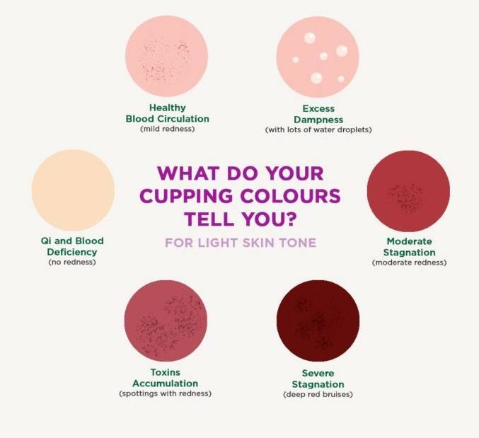 Acupuncture cupping color mark meanings