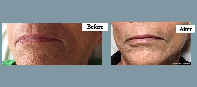 Facial Rejuvination for fine lines and wrinkles